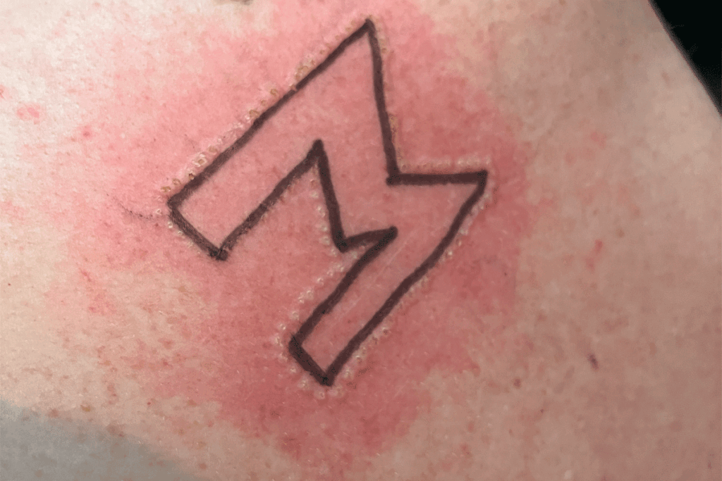 Cautery branding