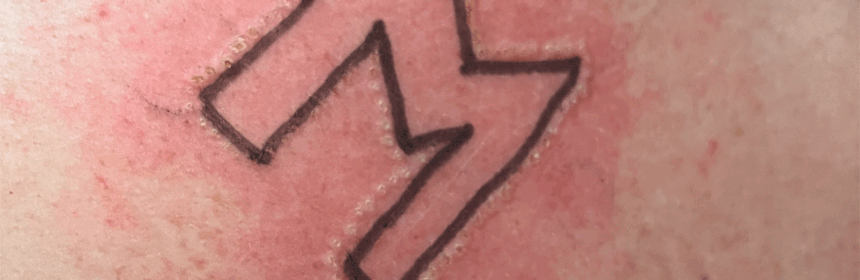 Cautery branding