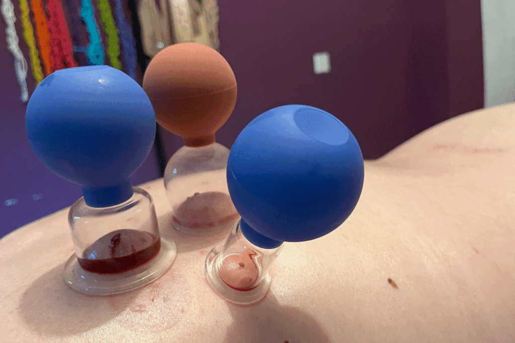 Blood cupping