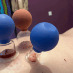 Blood cupping
