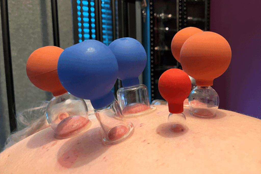 Cupping