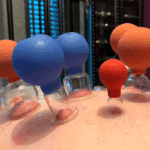 Cupping