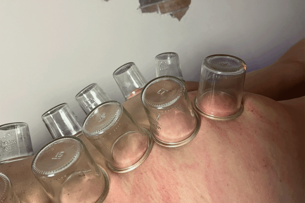 Firecupping